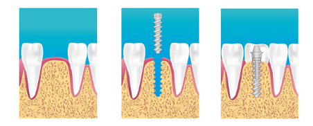 dentiste montauban implant dentaire explications dessin